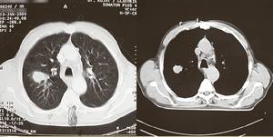 CT-Bilder eines Tumors in der rechten Lunge
