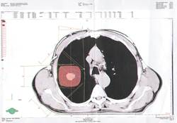 Lungentumor ohne Metastasen auf CT-Bild