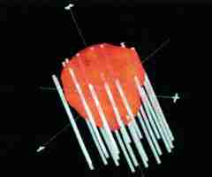 Abbildung 2: Grafische Darstellung einer Spickung der Prostata mit einzelnen Nadeln und Ablagerung von radioaktiven Seeds (rote Striche in den grauen Nadeln) aus dem  Planungsprogramm SPOT, Fa. Nucletron.