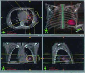 Computertomographie-Bild und dreidimensionale,<br>transparente Krperrekonstruktionen fr die Therapieplanung