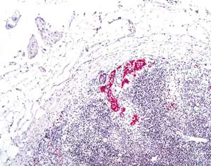 Mikrometastasen eines Melanoms