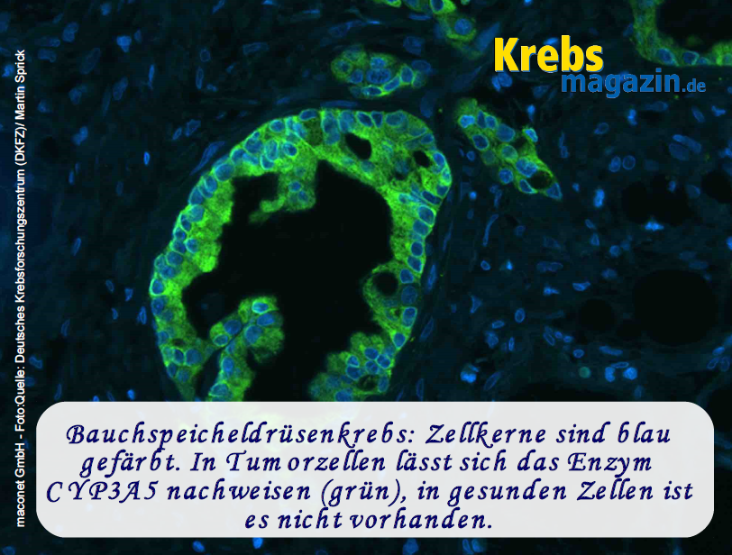 Bauchspeicheldrüsenkrebs_Stammzellen_DKFZ